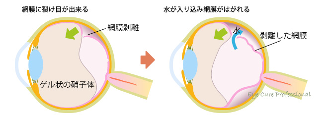 裂孔原性網膜剥離